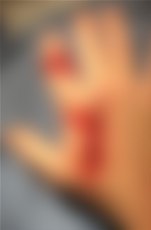 blurred bloody hand 14 stitches