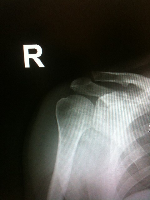 paul schuster shoulder x-ray paul schuster shoulder x-ray